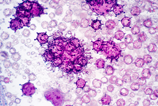 Certain other B-cell non-Hodgkin lymphomas