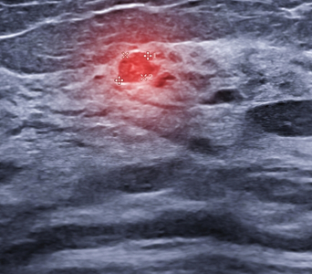 Assessing Dense Breasts