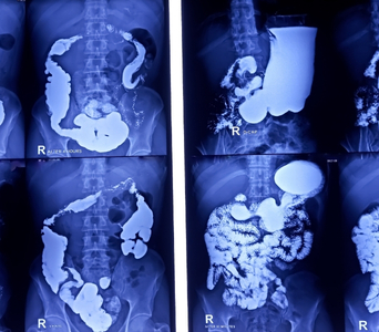 Colorectal Cancer Screening