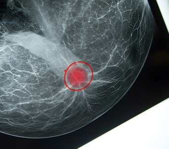 Detecting Small-Bowel Tumours