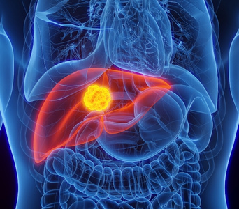 Assessing Biliary Cancers