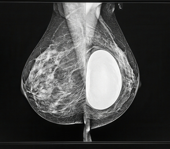 Evaluating Dense Breast Tissue