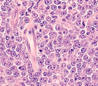 Investigating Lymphoma