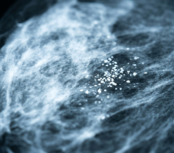 Detecting Calcifications and Other Changes