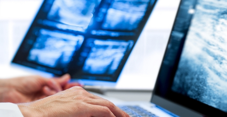 Digital Breast Tomosynthesis