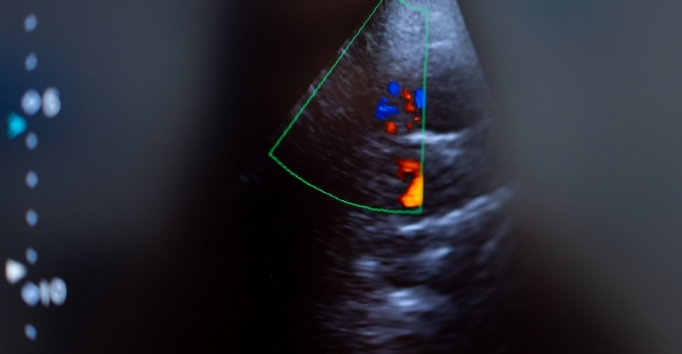 Ultrasound