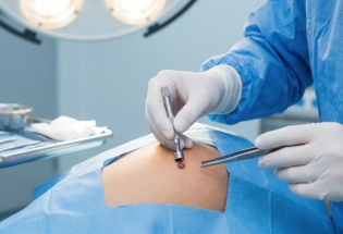 Surgical Biopsy