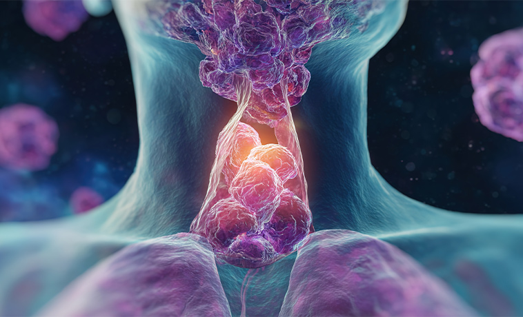 Radioiodine Therapy